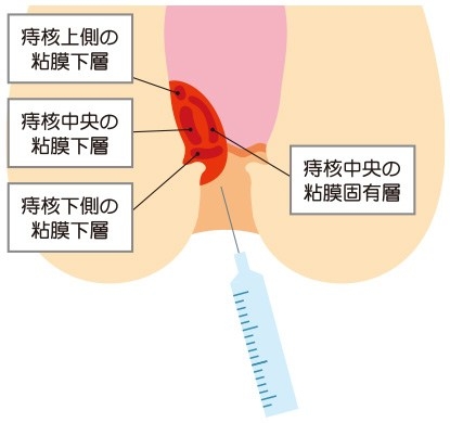 ジオン注射（ALTA療法）の効果について