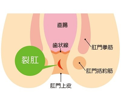 切れ痔とは（原因と症状）