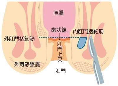 側方内括約筋切開術（LSIS）