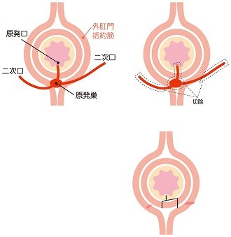 瘻管切開開放術