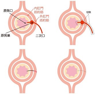 くり抜き法（括約筋温存術）