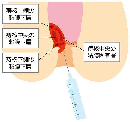 ジオン注射（ALTA療法）