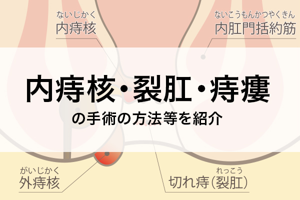 内痔核・裂肛・痔瘻の手術の方法等を紹介