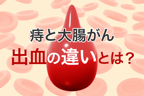 痔と大腸がんの出血の違いとは？