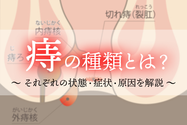 痔の種類とは？それぞれの状態・症状・原因を解説